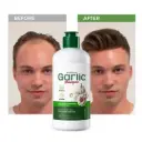  Shampoo Mite Removing Cleansing Soothes Scalp (SADOER)