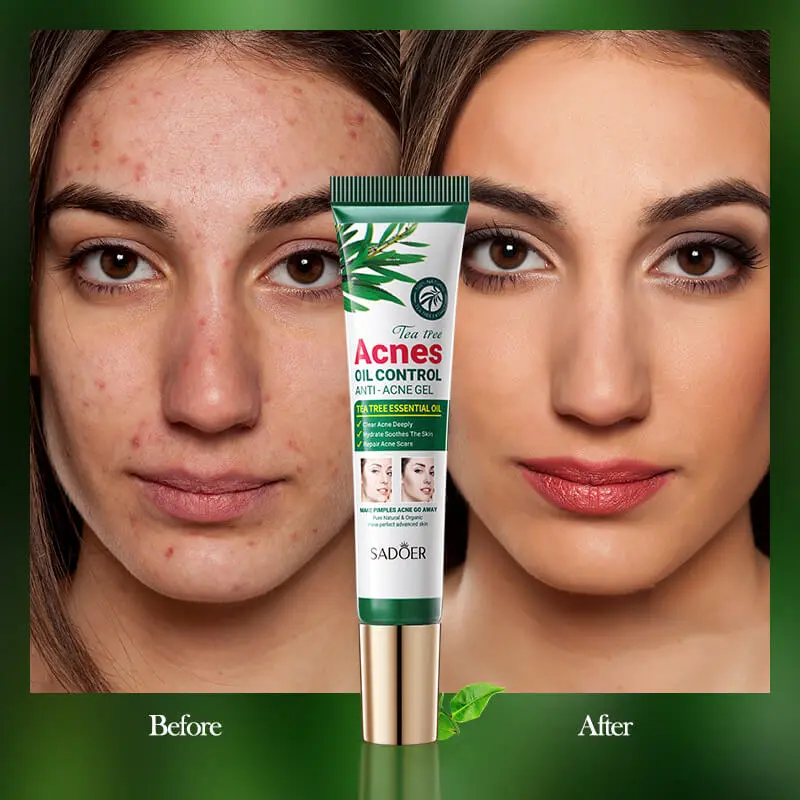 Gel Anti-Acné Et Contrôle Du Sébum À L'Huile D'Arbre À Thé (SADOER)