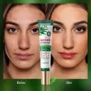 جل سادوير بزيت شجرة الشاي للتخلص من حب الشباب والتحكم بالزيوت (SADOER Tea Tree Acnes Oil Control Anti-Acne Gel)
