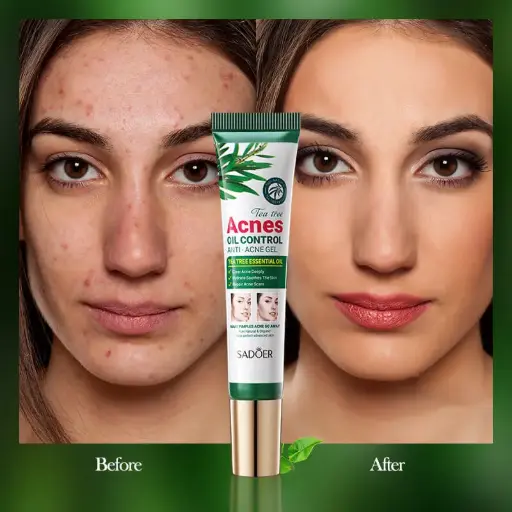 SADOER Tea Tree Acnes Oil Control Anti-Acne Gel
